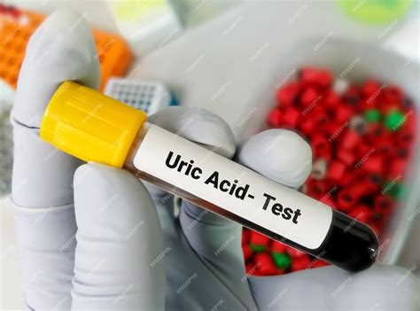 uric acid blood test bottle colour|uric acid blood test for gout.